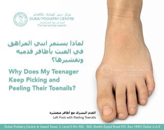 Teenager’s left foot with peeling toenails caused by repeated nail picking, assessed at Dubai Podiatry Centre