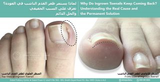 Top and front view of an ingrown toenail showing the nail edge growing into the surrounding skin, causing pain and inflammation. Educational image explaining the causes of recurring ingrown toenails and permanent treatment by Dubai Podiatry Centre