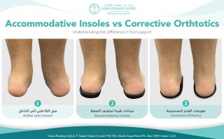 Comparison of inward-leaning ankles without support, with accommodative insoles, and with corrective orthotics
