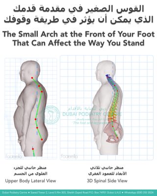 3D postural assessment showing how a collapsed forefoot transverse arch may affect standing posture and spinal alignment