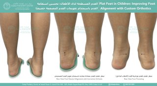 Child’s flat feet showing overpronation and improved neutral foot alignment with custom orthotics in Dubai