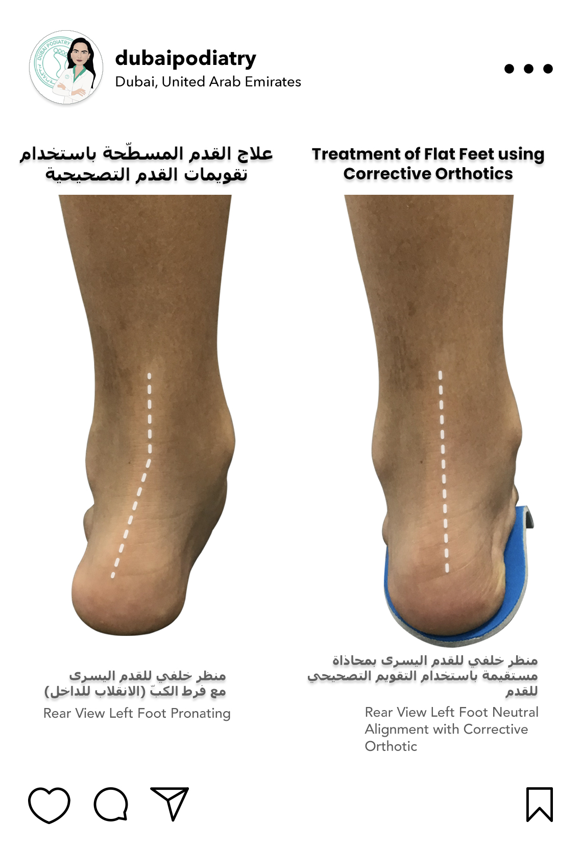https://dubaipodiatry.com/wp-content/uploads/2026/09/flat-feet-overpronation-corrective-orthotics-dubai.jpg