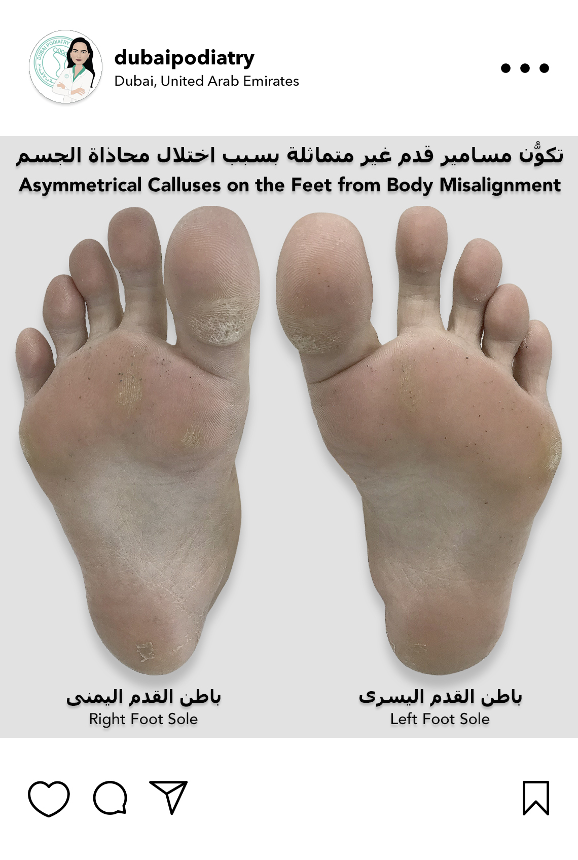 https://dubaipodiatry.com/wp-content/uploads/2026/10/asymmetrical-foot-calluses-body-misalignment-dubai.jpg