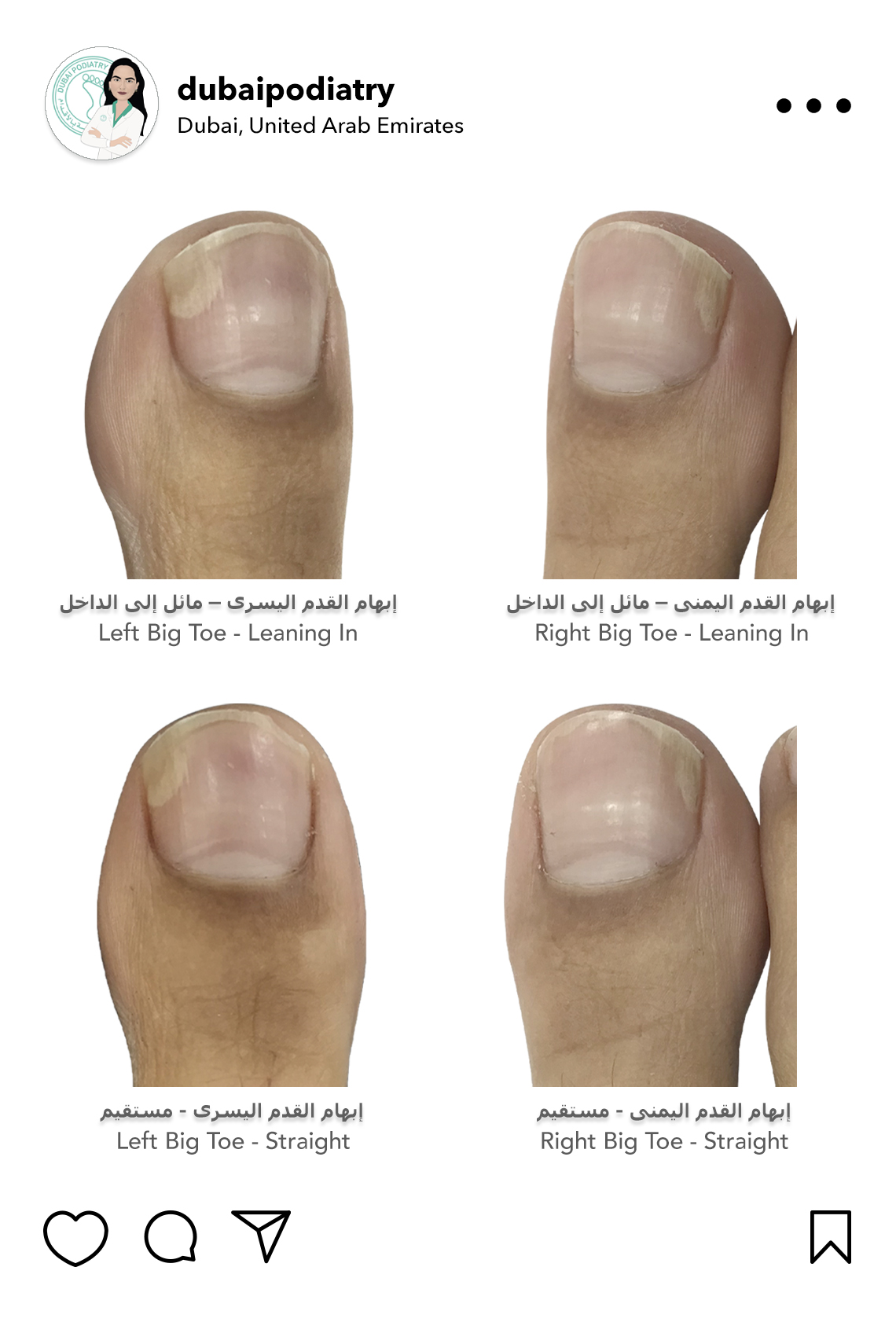 https://dubaipodiatry.com/wp-content/uploads/2026/10/big-toenail-separation-toe-alignment-dubai-podiatry-centre.jpg