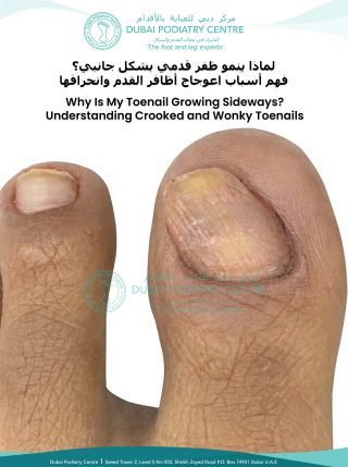 Close-up of a crooked big toenail growing sideways toward the second toe, illustrating the causes of angled and ingrown toenails discussed by Dubai Podiatry Centre