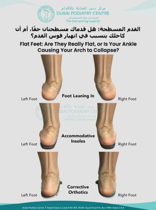 Foot alignment comparison showing inward leaning feet and examples of accommodative and corrective orthotics