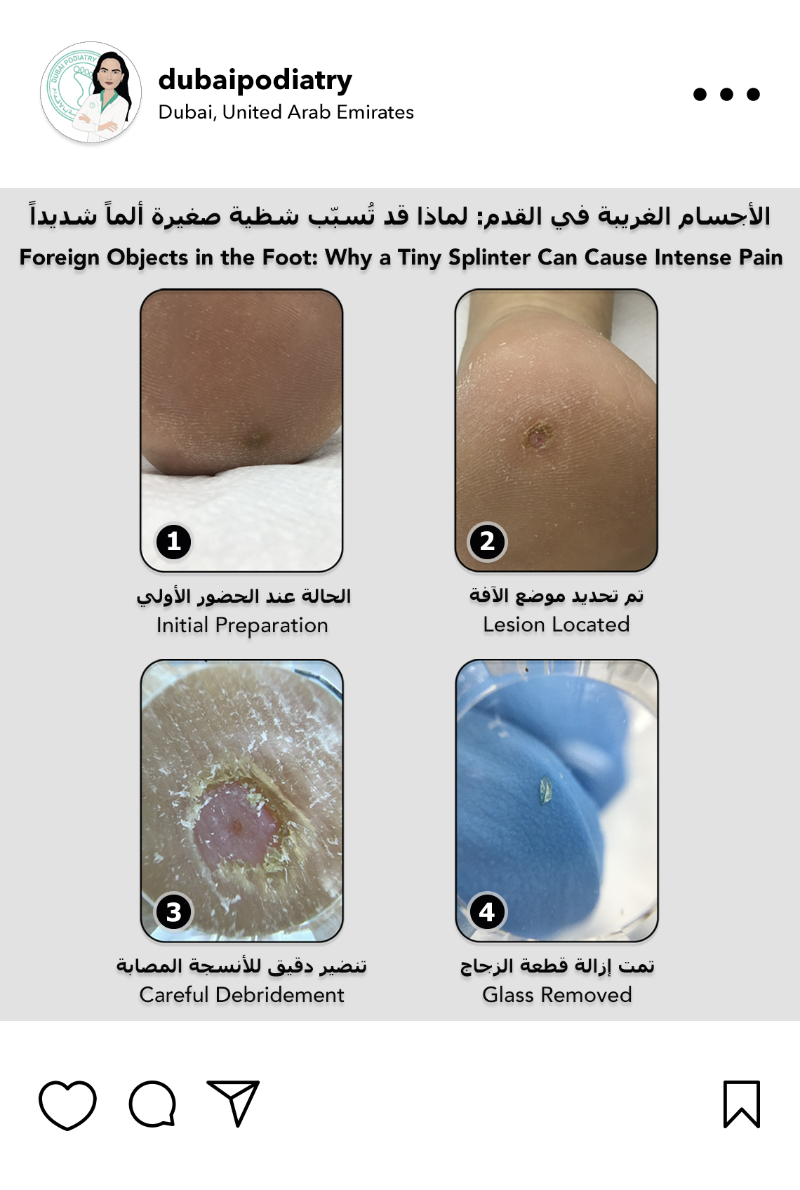 https://dubaipodiatry.com/wp-content/uploads/2026/10/glass-splinter-removal-foot-dubai-podiatry.jpg